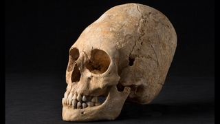 French Archaeologists Discover Beautifully Preserved Deformed Skull